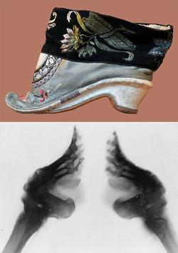 Вид бинтованной китайской ножки в туфлях – это одно, а под рентгеном – другое